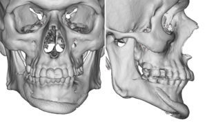 Chin Implant Mental Nerve Impingement