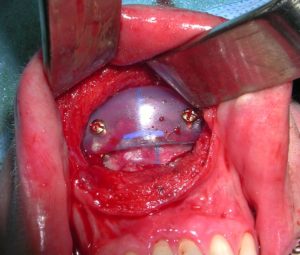 Chin Implant Stacking in Chin Augmentation Dr Barry Eppley Indianapolis