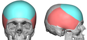 Custom Forehead Implant design Dr Barry Eppley Indianapolis