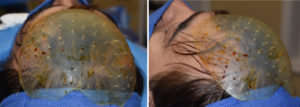 Custom Forehead Implant placement Dr Barry Eppley Indianapolis