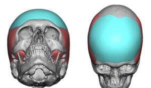 Custom Foreheasd Implant design 2 Dr Barry Eppley Indianapolis