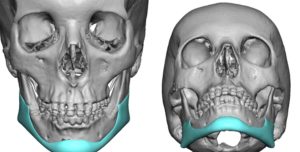 Custom Jawline Implanty after Jawline Reduction Surgery design front view Dr Barry Eppley Indianapolis