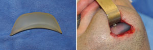 Custom Square Chin Implant placement Dr Barry Eppley Indianapolis