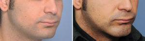 Custom Square Chin Implant result oblique view Dr Barry Eppley Indianapolis