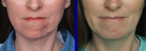 Dermal Fat Graft Chin Reconstruction result front view Dr Barry Eppley Indianapolis