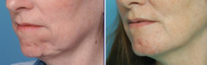 Dermal-Fat Graft Chin reconstruction result oblique view Dr Barry Eppley Indianapolis