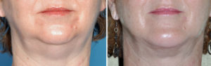 Double Chin Correction result front view Dr Barry Eppley Indianapolis