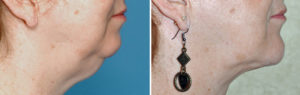 Double Chin Correction result side view Dr Barry Eppley Indianapolis