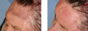 Fat Injections to Forehead Craniotomy Defect left oblique view Dr Barry Eppley Indianapolis