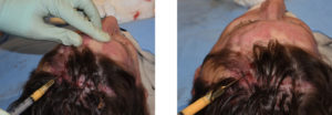 Fat Injections to Forehead Craniotomy Defect technique Dr Barry Eppley Indianapolis