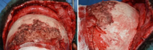 Hydroxyapatite Cement Forehead Augmentation Dr. Barry Eppley Indianapolis