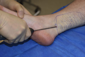 Inner Ankle Liposuction Dr Barry Eppley Indianapolis