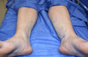 Inner Ankle Liposuction result Dr Barry Eppley Indianapolis