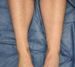Inner Ankle Liposuction result front view Dr Barry Eppley Indianapolis