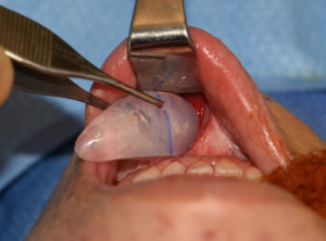 Intraoral Chin Implant placement Dr Barry Eppley Indianapolis