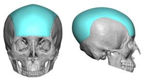 Large Custom Skull Implant design Dr Barry Eppley Indianapolis