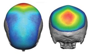 Large Custom Skull Implant design color mapping Dr Barry Eppley Indianapolis