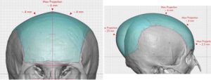 Large Custom Skull Implant dimensions Dr Barry Eppley Indianapolis