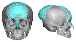 Large PMMA Skull Augmentation 3D CT images