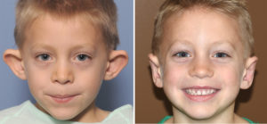 Male Child Otoplasty result front view Dr. Batrry Eppley Indianapolis