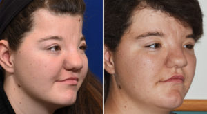 NN Forehead Augmentation with Hydroxyapatite Cement result oblique view Dr Barry Eppley Indianapolis