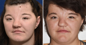 NN Forehead Augmentation withj Hydroxyapatite Cement result front view Dr Barry Eppley Indianapolis