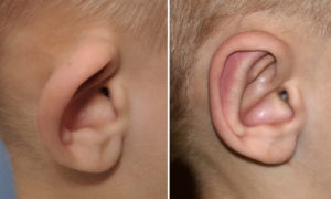 Pediatric Otoplasty result side view Dr Barry Eppley Indianapolis