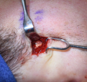 Posterior Zygomatic Arch Osteotomy Cut Dr Barry Eppley Indianapolis