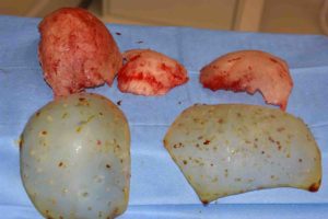 Remove and Replace Large Skull Augmentation intraop Dr Barry Eppley Indianapolis