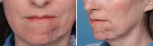 Soft Tissue Deformity of Chin