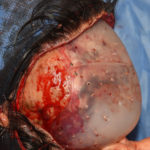 Two Piece Custom Skull Implant Dr Barry Eppley Indianapolis