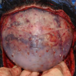 Two piece large custom skull implant top view Dr Barry Eppley Indianapolis
