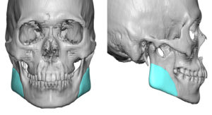 Vertical Lengthening Jaw Angle Implants Dr Barry Eppley Indianapolis