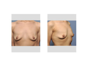 Weight Loss Breast Augmentation Female before surgery Dr Barry Eppley Indianapolis