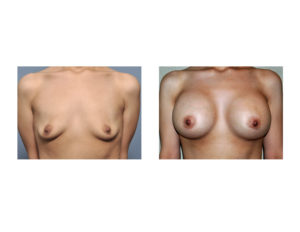 Weight Loss Breast Augmentation result front view Dr Barry Eppley Indianapolis