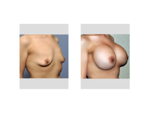 Weight Loss Breast Augmentation result right oblique view Dr Barry Eppley Indianapolis