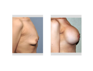 Weight Loss Breast Augmentation result side view Dr Barry Eppley Indianapolis