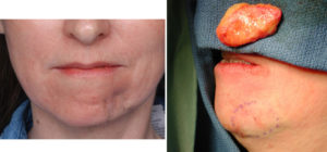 to chin intraop