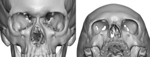 Bilateral Orbital Rim Fractures 3D CT scan Dr Barry Eppley Indianapolis