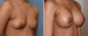 Breast Asymetry Augmentation result oblique view Dr Barry Eppley Indianapolis