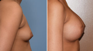 Breast Asymmetry Augmentation result side view Dr Barry Eppley Indianapolis