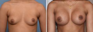 Breast Asymmetry Augmentationresult front view Dr Barry Eppley Indianapolis
