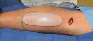 Calf Implant Incision Dr Barry Eppley Indianapolis