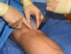 Calf implant insertion technique Dr Barry Eppley Indianapolis