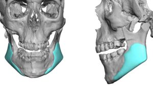 Custom Extended Vertical Jaw Angle Imlpants design Dr Barry Eppley Indianapolis