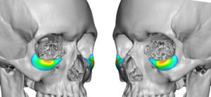 Custom Infraorbital Implants design Dr Barry Eppley Indianapolis