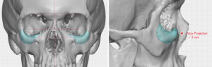 Custom Infraorbital Rim implants design for fracture treatment Dr Barry Eppley Indianapolis