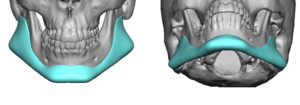Custom Jawline Implant Angle Widths Dr Barry Eppley Indianapolis