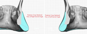 Custom Jawline Implant Angle design and dimensions Dr Barry Eppley Indianapolis