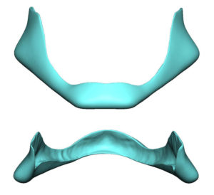 Custom Jawline Implant Flare Design Dr Barry Eppley Indianapolis
